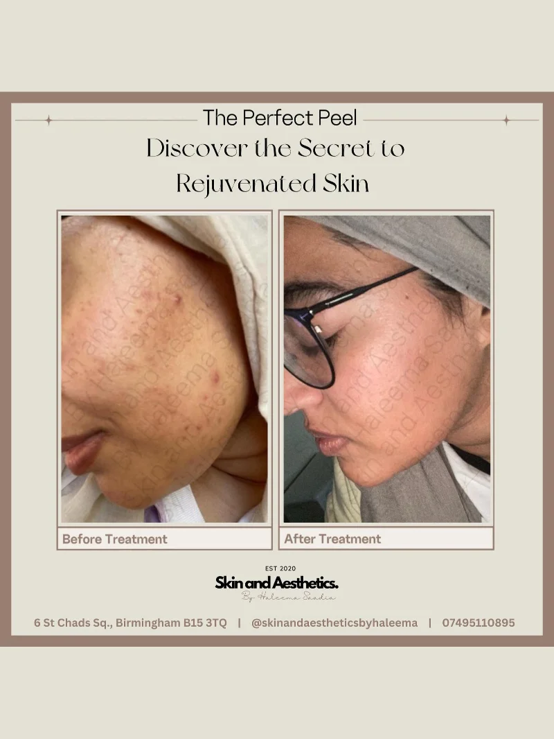 Facial treatment
